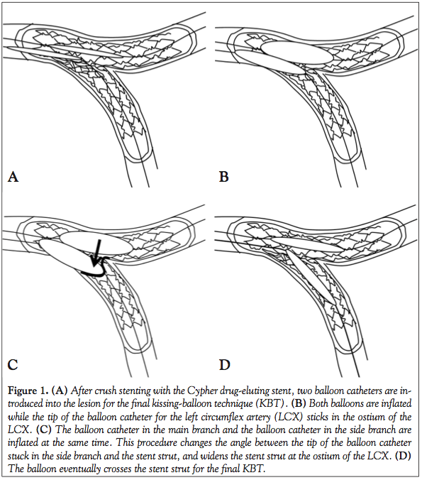 BuddyBalloon Technique for Final KissingBalloon Dilatation After Crush Stenting of the Left